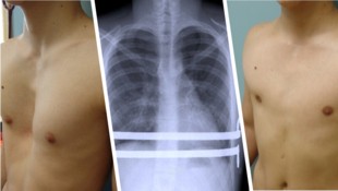 Links sieht man einen Patienten mit Trichterbrust vor, rechts nach erfolgreicher Behandlung.