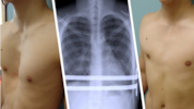 Links sieht man einen Patienten mit Trichterbrust vor, rechts nach erfolgreicher Behandlung.