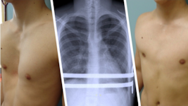 Links sieht man einen Patienten mit Trichterbrust vor, rechts nach erfolgreicher Behandlung.