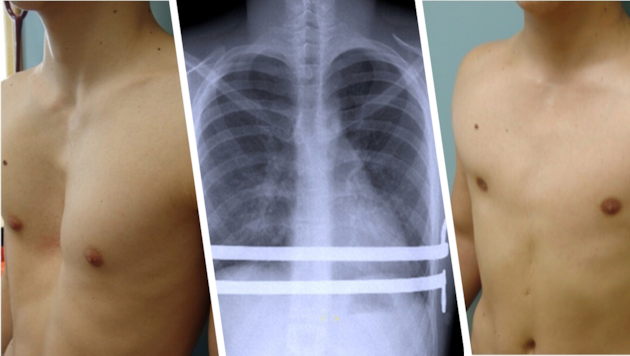 Links sieht man einen Patienten mit Trichterbrust vor, rechts nach erfolgreicher Behandlung.