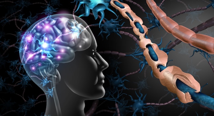 Bei MS greift das Immunsystem die Schutzhülle der Nervenfasern in Gehirn und Rückenmark an.