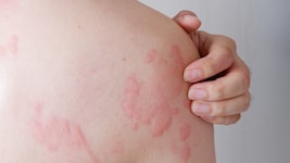 Die Nesselsucht geht mit Rötung und Quaddeln einher.