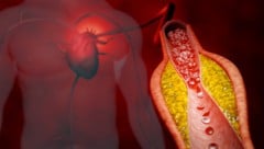 Ist das LDL über längere Zeit zu hoch, kann sich Cholesterin in den Blutgefäßen ablagern.