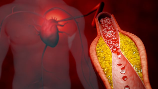 Ist das LDL über längere Zeit zu hoch, kann sich Cholesterin in den Blutgefäßen ablagern.