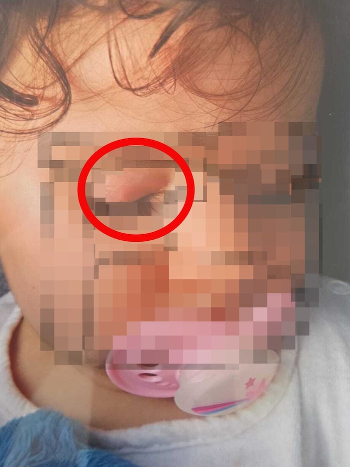 Bilder zeigen neben blauen Flecken auch Schwellungen (Kreis) und eine heftige Entzündung im ...