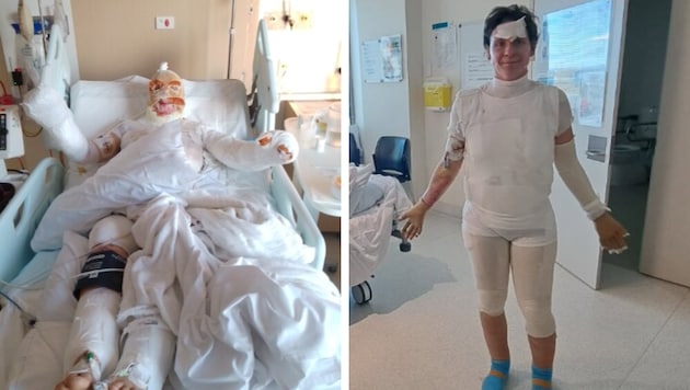 Katja Grosse überlebte die Gasexplosion – sie musste allerdings eine Hauttransplantation über ...