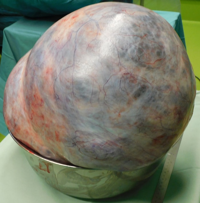 Der 18 Kilogramm schwere Tumor.