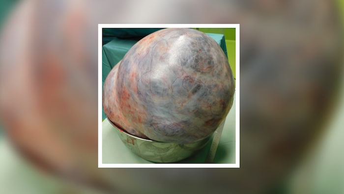 Der 18 Kilogramm schwere Tumor