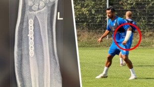 Mit einer Platte und sieben Schrauben im Arm kehrt der mit einer Schiene versehene Ronivaldo am ...