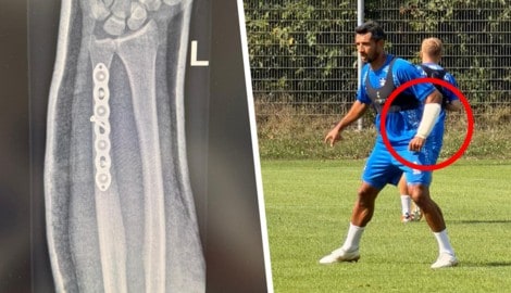 Mit einer Platte und sieben Schrauben im Arm kehrt der mit einer Schiene versehene Ronivaldo am ...