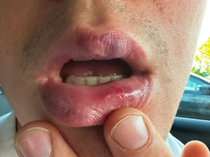 Der 27-Jährige trug eine blutige Lippe davon.