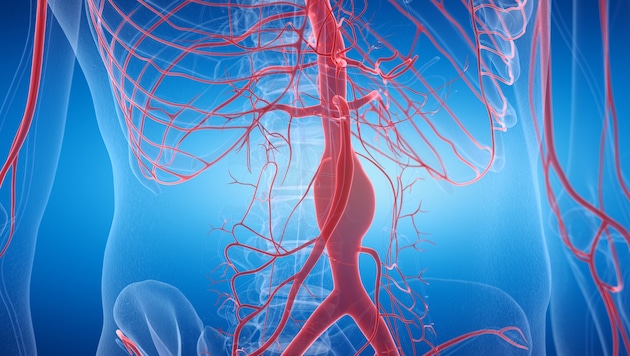 Ein Aortenaneurysma bleibt lange unerkannt. Ein Riss endet häufig tödlich.