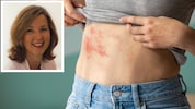 Dr. Claudia Heller-Vitouch erklärt, wie Gürtelrose entsteht und was man dagegen tun kann.
