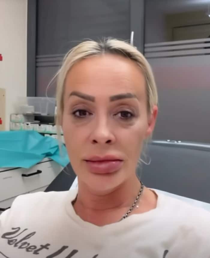 Cora Schumacher zeigt auf Instagram ihre extrem angeschwollene Lippe.