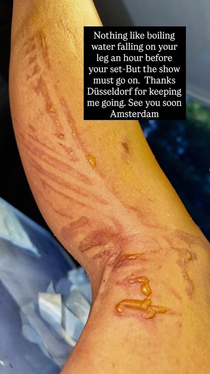 In ihrer Instagram-Story zeigte Nicole Scherzinger das Ausmaß ihrer Verbrühungen. Das sieht ...