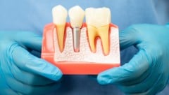 Bei Implantaten besteht noch Informationsbedarf.