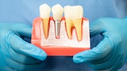 Bei Implantaten besteht noch Informationsbedarf.