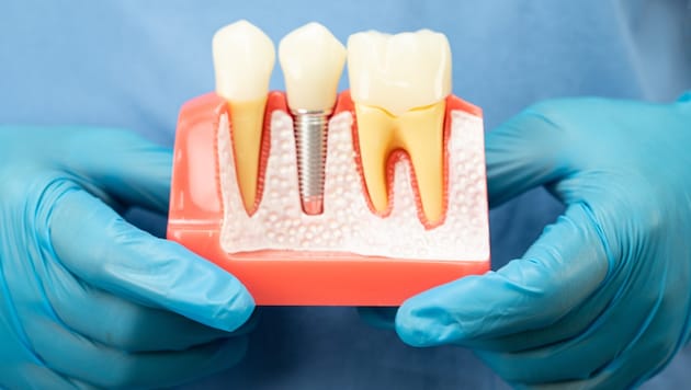 Bei Implantaten besteht noch Informationsbedarf.
