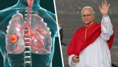 Lungenkrebs: Papst Leo wurde ein Teil der Lunge entfernt.