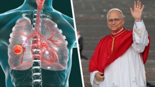 Lungenkrebs: Papst Leo wurde ein Teil der Lunge entfernt.