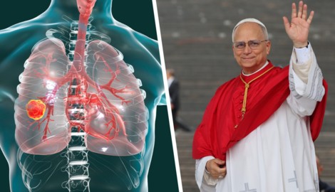 Lungenkrebs: Papst Leo wurde ein Teil der Lunge entfernt.
