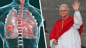 Lungenkrebs: Papst Leo wurde ein Teil der Lunge entfernt.