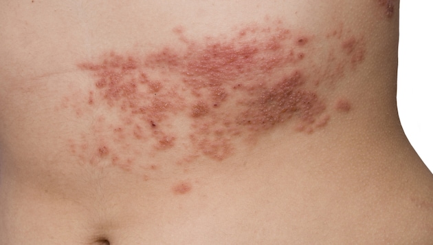 Zu den entzündeten Bläschen kommen bei Gürtelrose oft unerträgliche Schmerzen dazu.