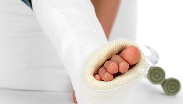 Eine Ruhigstellung mittels Gips ist ein Kriterium für eine Gehunfähigkeit (Symbolbild).