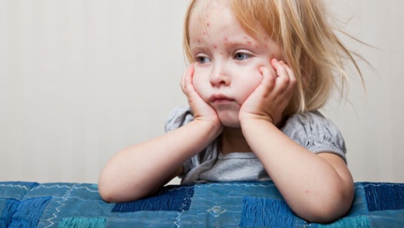 Masern können tödlich enden. (Bild: thinkstockphotos.de (Symbolbild))