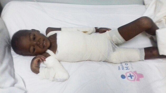 Die sechsjährige Fatuma erlitt schwerste Verbrennungen. Dank Asante konnte ihr geholfen werden. (Bild: Asante)
