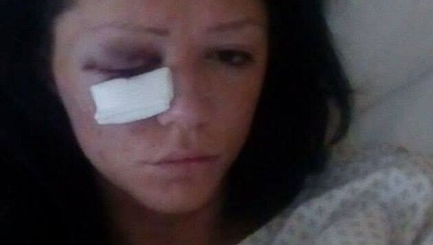 Die 21-Jährige lag mit gebrochener Augenhöhle im Spital, suchte online nach der Täterin. (Bild: Krone)