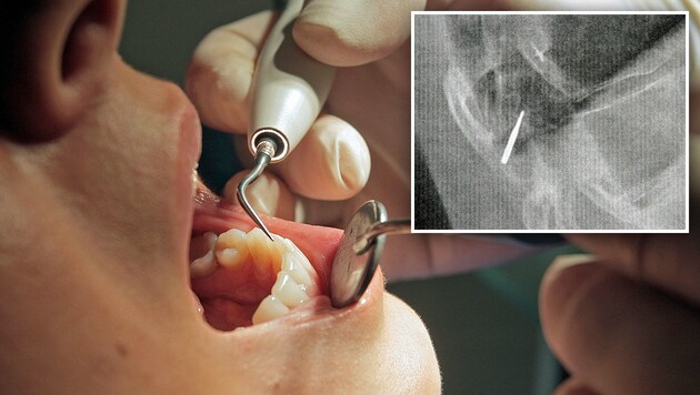 Der Zahnarztbesuch einer Steirerin endete äußerst schmerzhaft und im Krankenhaus. (Bild: APA/GEORG HOCHMUTH, Christian Jauschowetz)