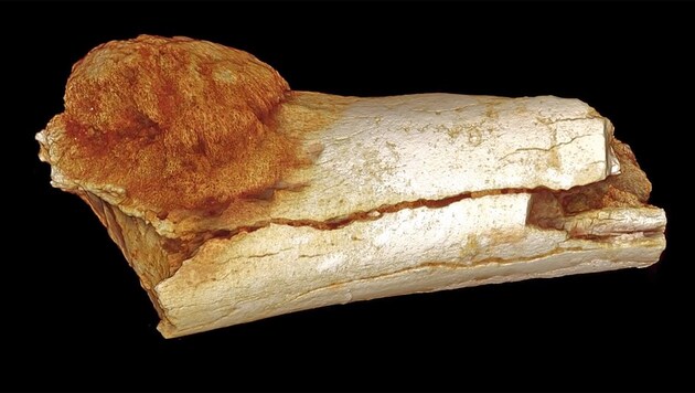In diesem Fußknochen fanden die Forscher den ältesten bösartigen Tumor. (Bild: YouTube.com/Wits University Official)