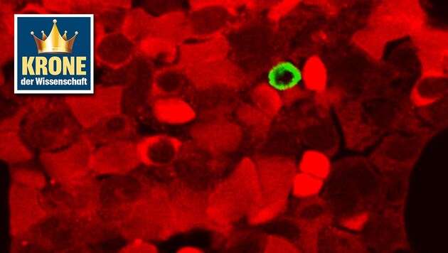 Eine grüne Stammzelle in normalem, rot eingefärbtem Knochenmark (Bild: Labor Lepperdinger)