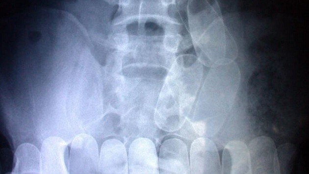 Das sind verschluckte Drogenpackerl am Röntgenbild. (Bild: Andi Schiel (Symbolbild))