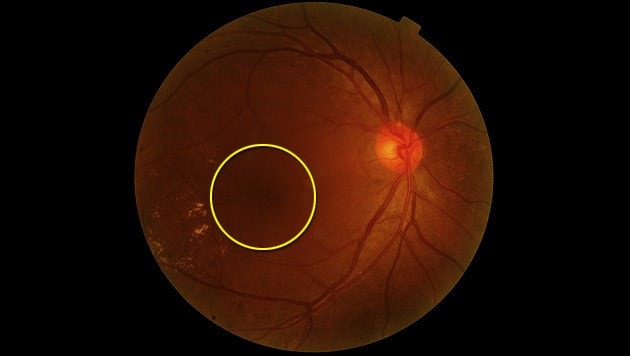 Ansicht des Augenhintergrundes, im Zentrum die Makula (gelb markiert) (Bild: thinkstockphotos.de)