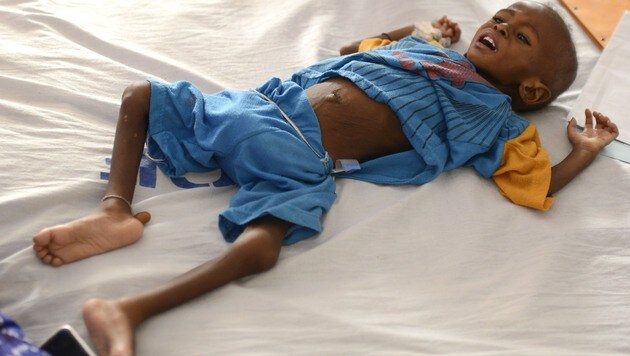 Sada (18 Monate) wiegt 5,3 Kilogramm. Neben der schweren Unterernährung leidet er auch an Malaria. (Bild: APA/HELMUT FOHRINGER)