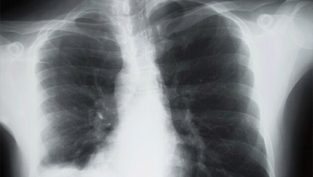 Lungenkrebs (Bild: thinkstockphotos.de)