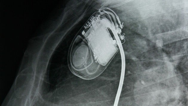 Die Röntgenaufnahmen zeigen einen Herzschrittmacher (Bild: thinkstockphotos.de)